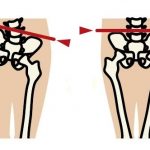 骨盤の歪み 歪みチェック編の詳細へ